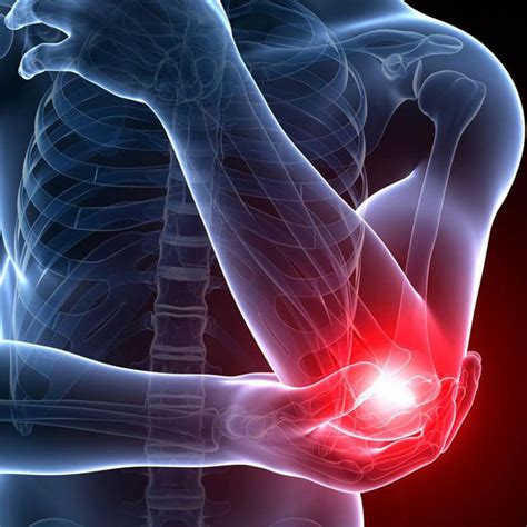 EPICONDILITIS LATERAL: "CODO DE TENISTA" Y RECUPERACIÓN - Corporis ...