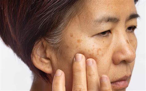 Melasma vs. Sun Spots | Identify and Treat Skin Pigmentation
