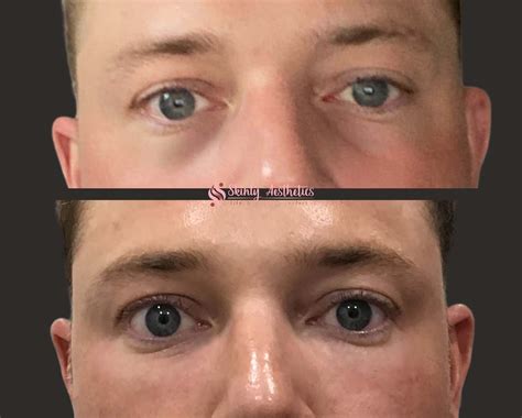 Juvederm Eyes