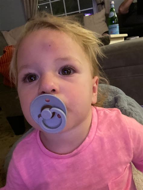 Head Injury Goose Egg