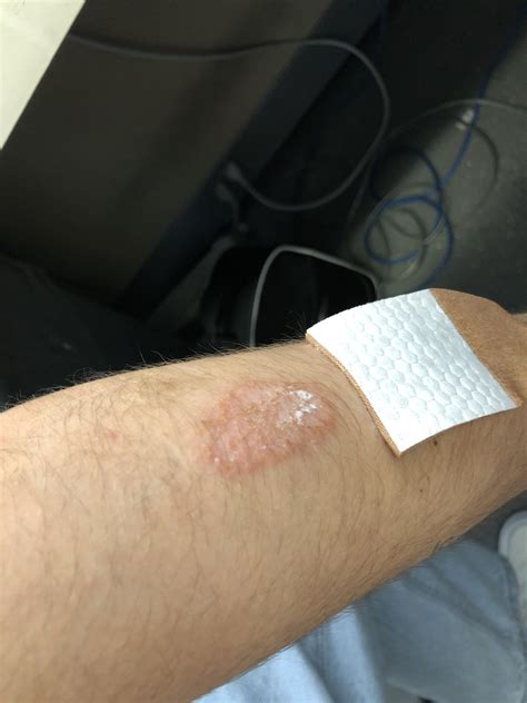 Any recommendation as to how to get rid of this? It started off as small ringworm and was using ... - how small is ringworm