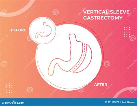 Laparoscopic Sleeve Gastrectomy, Vertical Gastrectomy, Weight Loss Surgery Vector Illustration ...
