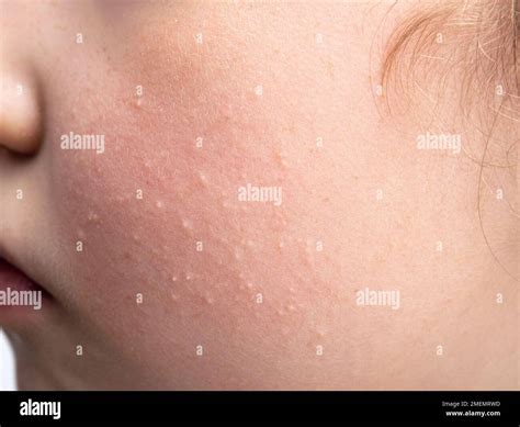 Small Milia (milk spots) are white cysts on 8 year old girl child cheek ...