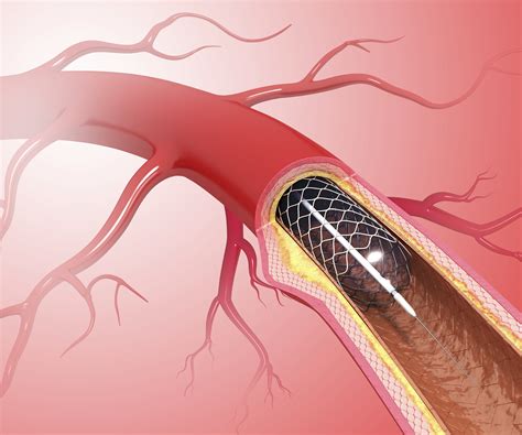 Stent In The Heart