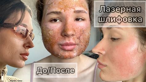 Лазерная шлифовка: что это такое, лазерный пилинг