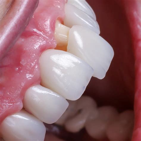What is a dental crown? Types, prices, real photos and duration