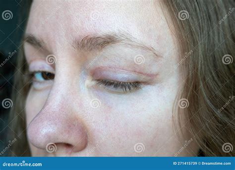 Woman Face after Plastic Surgery on Eyes, Blepharoplasty Operation, Incisions Stitches, Healing ...