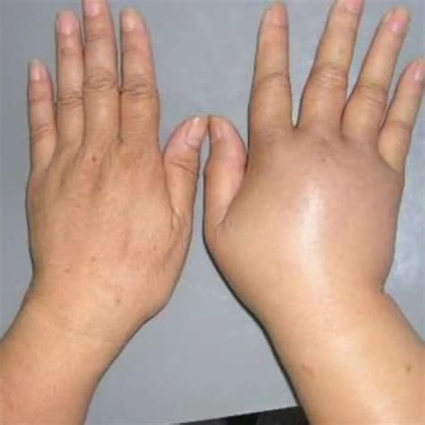 Waking Up With Swollen Hands