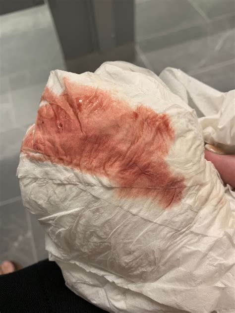 Menstrual Bleeding Vs Implantation Bleeding