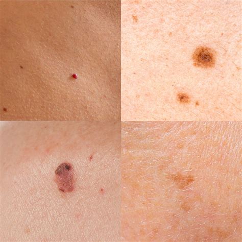 Different Types of Melanoma & Non-Melanoma Skin Cancer - Skin Institute