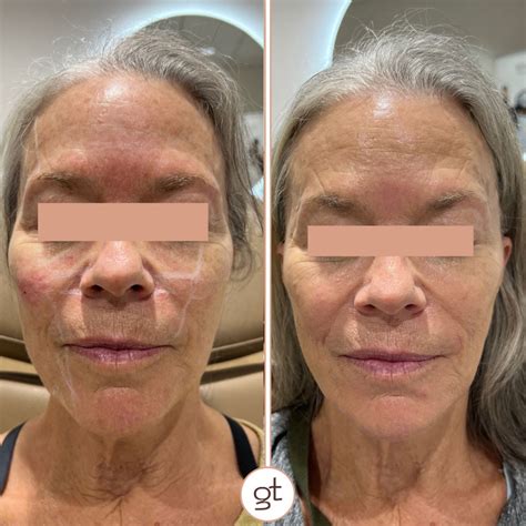 Before and After Gallery Dermal Fillers - Stunning Transformations