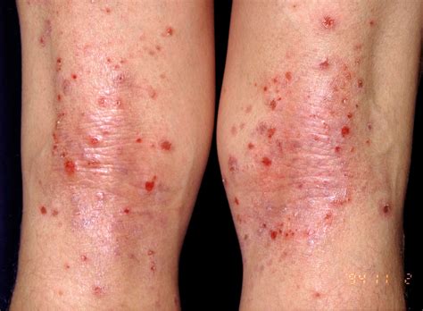 Eczema Bumps On Legs