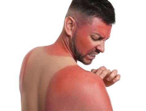 How to Stop Sunburn Itch | Center One Medical