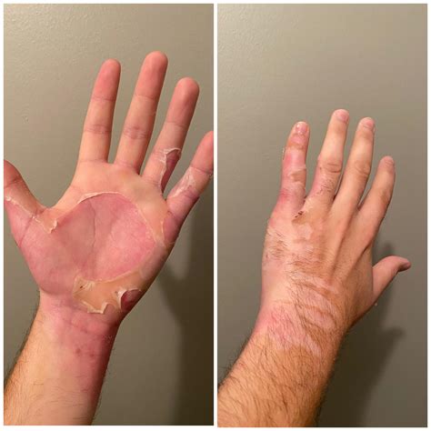 2nd Degree Burns On Hands Burn Injuries (Chapter 8) Color Atlas Of