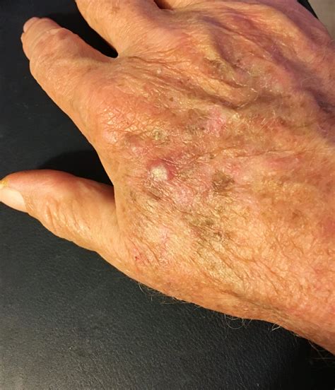 High Rates of Actinic Keratosis Lesion Recurrence, Even After Clearance - Dermatology Advisor