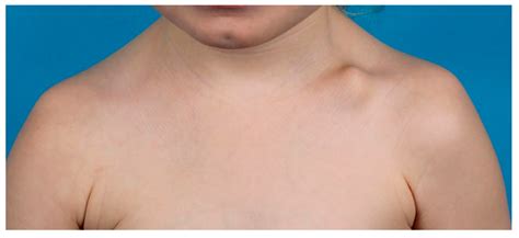 Pediatric Clavicle Fractures and Congenital Pseudarthrosis Unraveled
