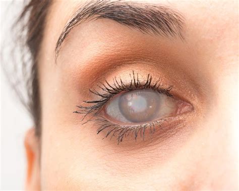 Eye Conditions | Dr Robin Abell - Cornea, Cataract & Refractive Surgeon