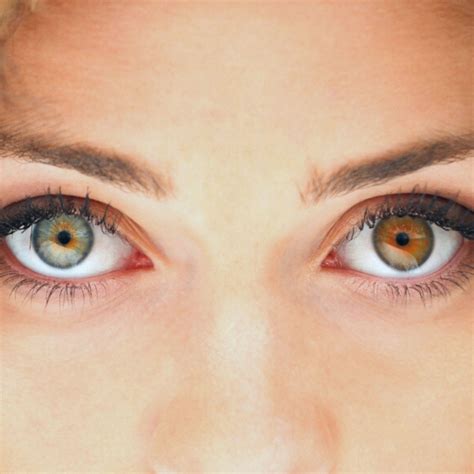 How rare is heterochromia in humans – Artofit