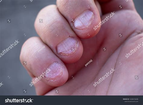 Severely Bitten Nails