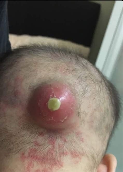 Cyst At Back Of Head