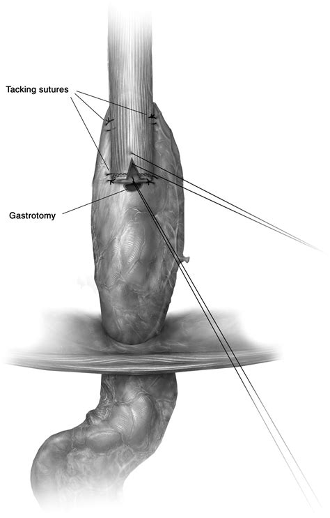 Technique of Open Ivor Lewis Esophagectomy - Operative Techniques in Thoracic and Cardiovascular ...