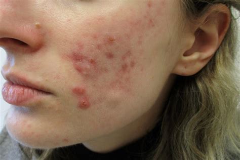 Acne On Cheeks