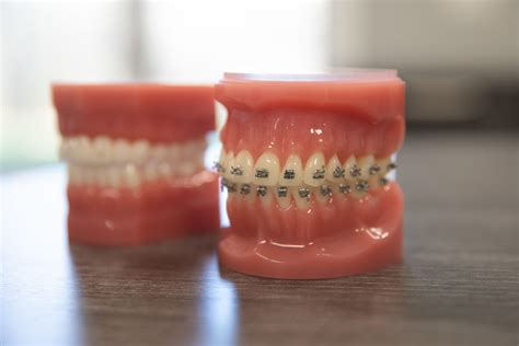 Metal Braces - Denlinger Orthodontics