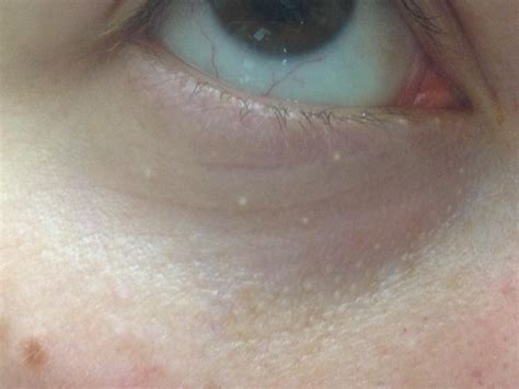 [Skin Concerns] Can anyone help me identify these small white bumps around my eyes? : r ...
