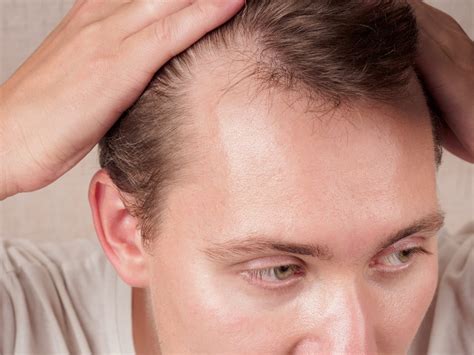 Widows Peak Hairline: Complete Guide & Cost Analysis