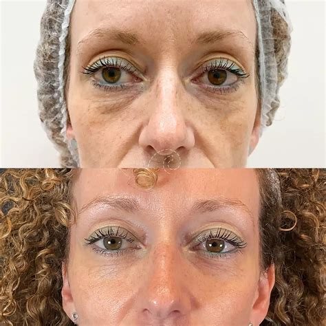 Fat Injections Under Eyes: Cost, Recovery, and Results