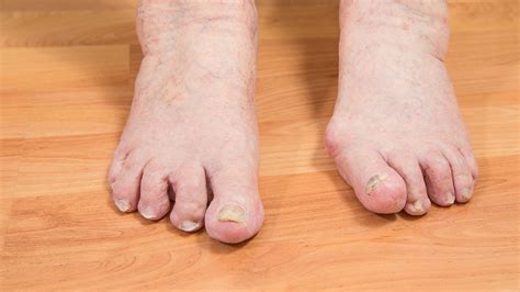 What Is Hammer Toe Deformity - Design Talk