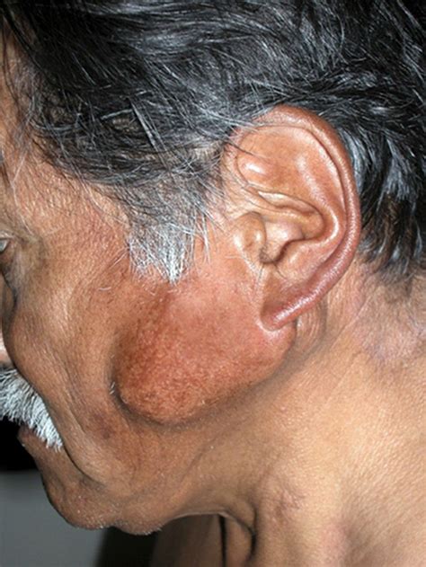 Salivary Gland Tumors - Ear, Nose, and Throat Disorders - Merck Manual Professional Edition