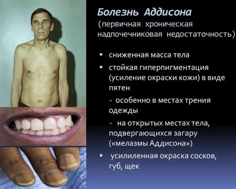 Болезнь Аддисона, симптомы Бронзовой болезни