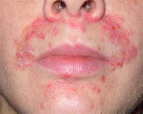 Perioral dermatitis causes, symptoms, diagnosis & treatment