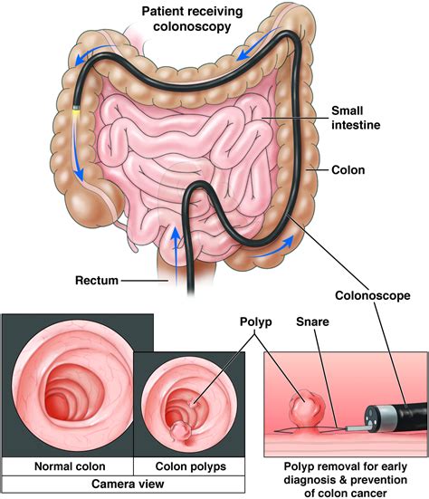 Colonoscopy - AGA GI Patient Center