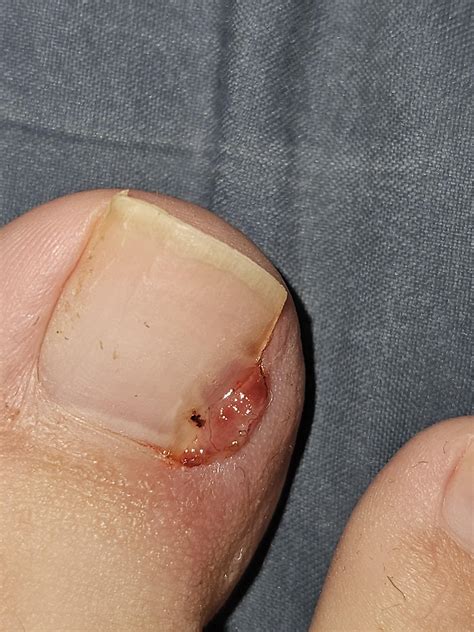 6 weeks after partial nail avulsion getting worse? : r/Ingrown_Toenails