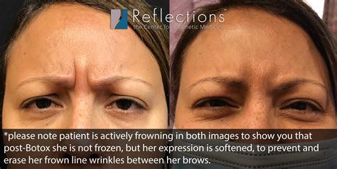 Best Treatment for Frown Lines Near Me New Jersey | Forehead Wrinkles