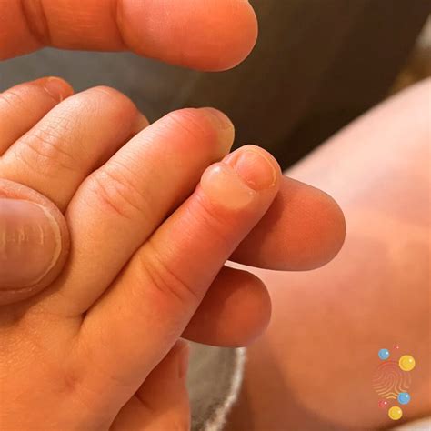 Herpetic Whitlow Finger Treatment 3 Common Infections Of The Hand And