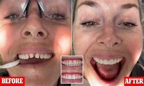 Taylor Swift Teeth Before Veneers