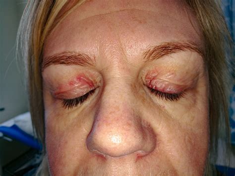 Eczema Eyelid Dermnet at Lyn Romano blog