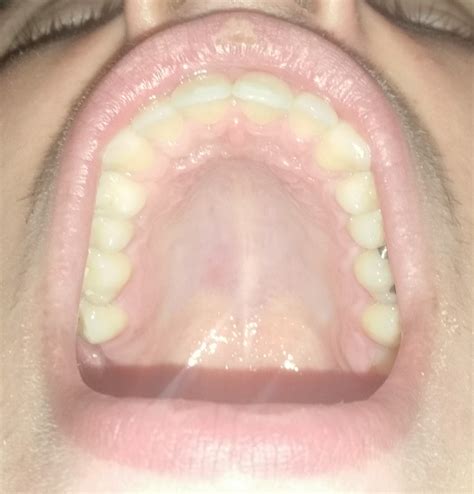 Developed a small bump on the roof of my mouth. A little worried about ...