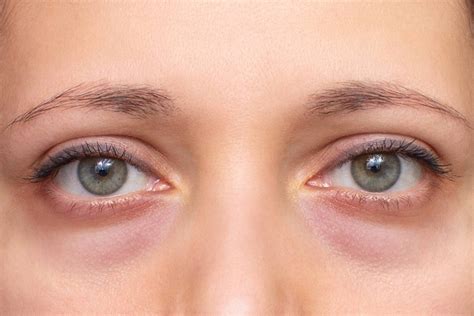 What Causes Under-Eye Bags & How Can You Get Rid of Them?