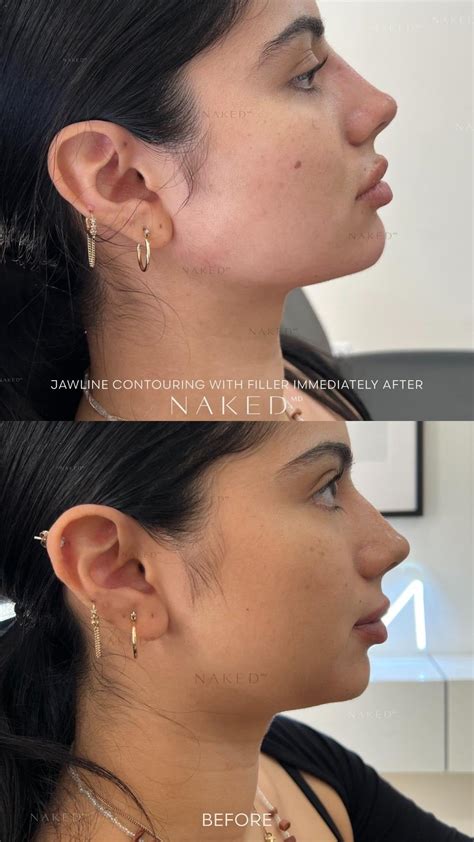 Jawline Dermal Fillers | Jawline Contouring in CA & AZ – NAKEDMD Medspa