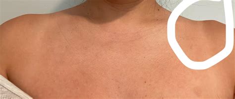 Bone protruding on my shoulder. anyone know what is this? And what ...