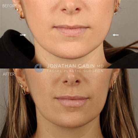 Facial Slimming Procedures Before & Afters | Dr. Jonathan Cabin