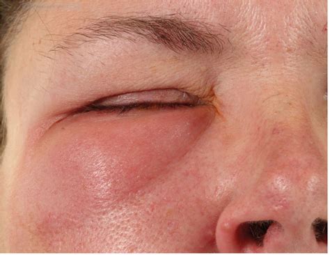 Recurrent unilateral preseptal cellulitis secondary to herpes simplex ...