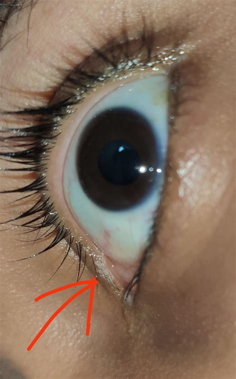 Super dry eyes at night & when waking up : r/Dryeyes