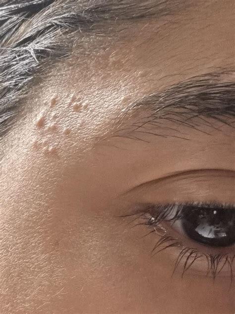 small pimple groups on both temples. please help : r/Dermatology