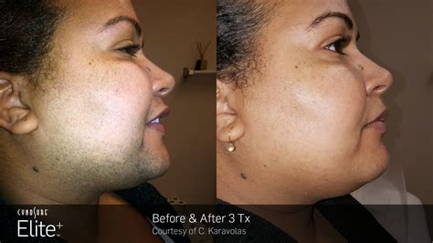 Permanent Laser Hair Removal - Some Questions and Answers - Innovations Skin Clinic