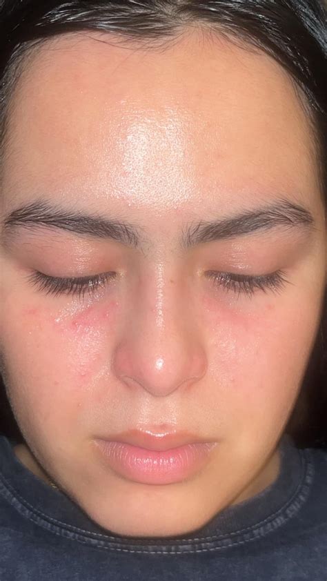 New red bumps under eyes : r/SkincareAddicts